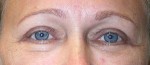 Eyelid Surgery (Blepharoplasty)