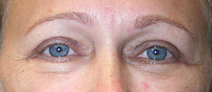 Eyelid Surgery (Blepharoplasty)