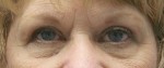 Eyelid Surgery (Blepharoplasty)