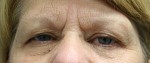 Eyelid Surgery (Blepharoplasty)