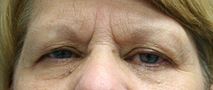 Eyelid Surgery (Blepharoplasty)