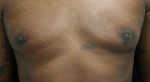 Gynecomastia (Male Breast Reduction Surgery)