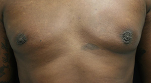 Gynecomastia (Male Breast Reduction Surgery)