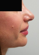 Nose Surgery (Rhinoplasty)