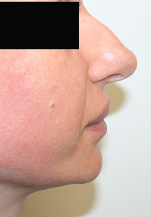 Nose Surgery (Rhinoplasty)