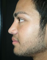 Nose Surgery (Rhinoplasty)