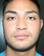 Nose Surgery (Rhinoplasty)