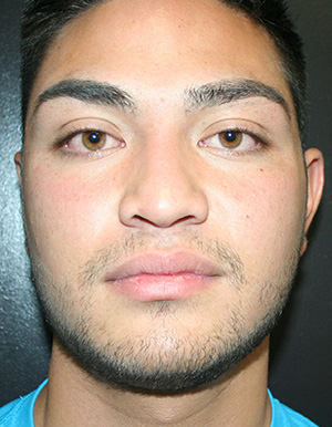 Nose Surgery (Rhinoplasty)