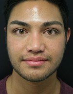 Nose Surgery (Rhinoplasty)