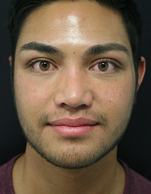 Nose Surgery (Rhinoplasty)