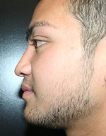 Nose Surgery (Rhinoplasty)