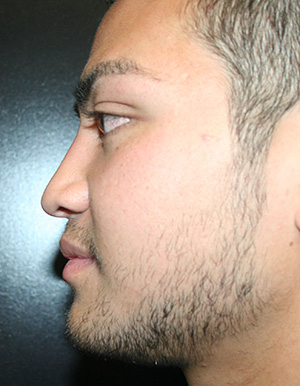 Nose Surgery (Rhinoplasty)