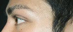 Eyelid Surgery (Blepharoplasty)