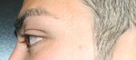 Eyelid Surgery (Blepharoplasty)