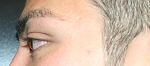 Eyelid Surgery (Blepharoplasty)