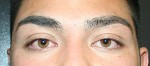 Eyelid Surgery (Blepharoplasty)