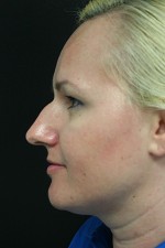 Nose Surgery (Rhinoplasty)