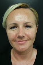 Nose Surgery (Rhinoplasty)
