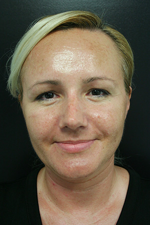 Nose Surgery (Rhinoplasty)