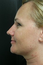 Nose Surgery (Rhinoplasty)