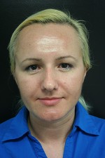 Nose Surgery (Rhinoplasty)
