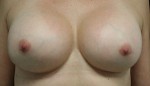 Breast Augmentation
