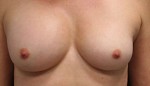 Breast Augmentation