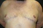 Gynecomastia (Male Breast Reduction Surgery)
