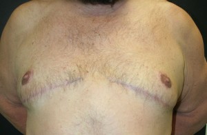 Gynecomastia (Male Breast Reduction Surgery)