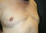 Gynecomastia (Male Breast Reduction Surgery)