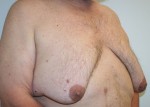 Gynecomastia (Male Breast Reduction Surgery)