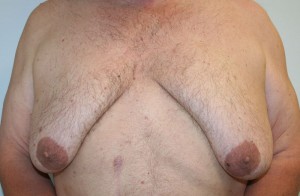 Gynecomastia (Male Breast Reduction Surgery)
