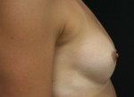 Breast Augmentation