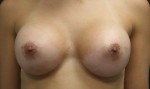 Breast Augmentation