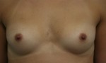 Breast Augmentation