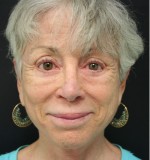 Nose Surgery (Rhinoplasty)