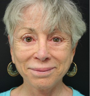 Nose Surgery (Rhinoplasty)