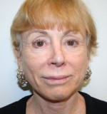 Nose Surgery (Rhinoplasty)