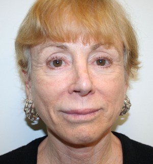 Nose Surgery (Rhinoplasty)