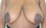 Breast Reduction (Reduction Mammaplasty)