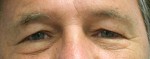 Eyelid Surgery (Blepharoplasty)