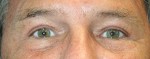 Eyelid Surgery (Blepharoplasty)