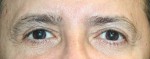 Eyelid Surgery (Blepharoplasty)