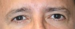 Eyelid Surgery (Blepharoplasty)