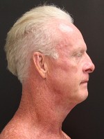 Face Lift
