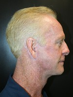Face Lift